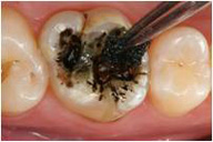 Imagen que muestra como se plica el caries detector oscuro en la superficie dental. 