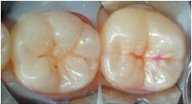 Imagen que muestra como queda el esmalte después de lavar el caries detector.
