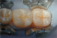 Molares sin caries. Imagen que muestra tres molares aislados y sin caries.
