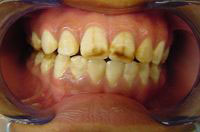 Imagen que muestra la boca de un paciente con fluorosis severa.