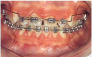 Imagen que muestra hipertrofia gingival por ortodoncia.