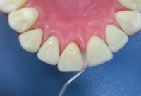 Imagen que muestra como debe serla inserción del instrumento en dientes anteriores por palatino.