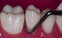 Imagen que muestra como debe insertarse la cureta entre los dientes.