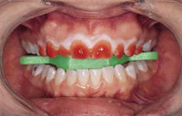 Muestra como se debe aplicar el gel en las piezas dentarias.