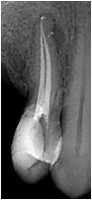 Imagen que muestra una radiografía de un premolar endodonciado.