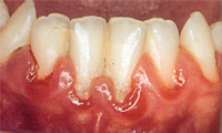 En la foto de observa una gingivitis por acumulo de placa bacteriana.