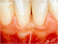 La imagen muestra un margen gingival sano.