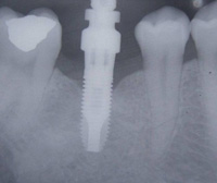 La imagen muestra una radiografía de un implante dental.