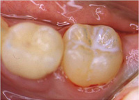 La imagen muestra un sellador blanco colocado en la cara oclusal de un molar permanente.