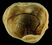 Se observa una pieza anatómica correspondiente a un teratoma ovárico (o quiste dermoide), donde se aprecia la formación quística que incluye diferentes tipos de tejido, destacando especialmente la presencia de pelos.