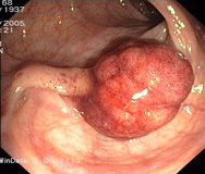 Imagen endoscópica de un pólipo en el sigma.