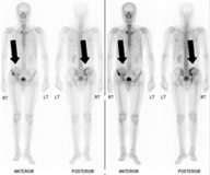 Gammagrafía que muestra metástasis óseas en la pelvis derecha, provenientes de un carcinoma hepatocelular.