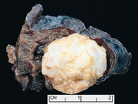 Imagen de un espécimen anatomopatológico de un tumor de pulmón (hamartoma) de menos de 2 cm. de diámetro. El tamaño se utiliza en la estadificación de los tumores.