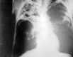En la imagen se observan las lesiones típicas de una tuberculosis pulmonar bilateral y lesiones cavitadas en la zonas pulmonar superior derecha.