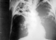 En la imagen se observan las lesiones típicas de una tuberculosis pulmonar bilateral y lesiones cavitadas en la zonas pulmonar superior derecha.