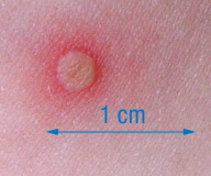 En la imagen se observa una vesícula ampollosa cutánea ligeramente elevada rodeada por una zona eritematosa.