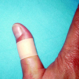 Dedo pulgar con lesión cubierta con un apósito impermeable.