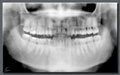 Imagen en la que se observa una radiografía panorámica u ortopantomografía de una persona adulta con toda la dentición permanente erupcionada.