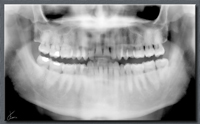 Imagen en la que se observa una radiografía panorámica u ortopantomografía de una persona adulta con toda la dentición permanente erupcionada.