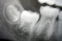 En la fotografía se pueden apreciar los tres molares inferiores derechos, el segundo y tercer molar se encuentran en formación. En los molares podemos apreciar los tejidos dentarios más densos, (esmalte, dentina y cemento) de color blanco (radiopacos) y la pulpa  de color oscuro (radiotransparente).