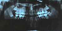 En la imagen se aprecia una ortopantomografía en la que se observa el 3r molar inferior derecho incluido e invertido. La imagen presenta una excesiva densidad.