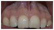 Apariencia gingival.