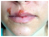 Herpes labial.