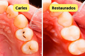 Caries: qué son, cómo identificarlas y tratamiento - Tua Saúde