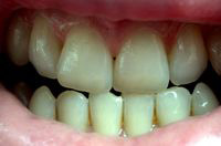 Dientes con un color natural.