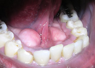 Imagen de una boca con placa supragingival.