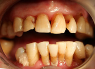 Imagen de una boca con placa subgingival.