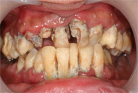 Formación placa supragingival por mala higiene.