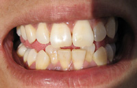 Apiñamientos dentales.