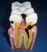 Sección dental con caries de los tejidos.