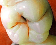 Imagen donde se puede apreciar una caries de fosa.