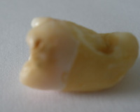 Imagen donde se puede apreciar una caries de superficie lisa.