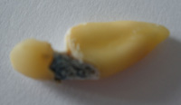 Imagen donde se aprecia una caries de la uniñon amelocementaria.