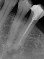 Se aprecia la radiografía de un diente.