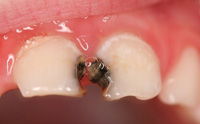 Se observan los incisivos superiores de un lactante con caries.