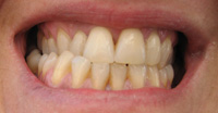 Dentadura con placa dental.