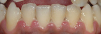 Encías con gingivitis ulceronecrótica aguda.