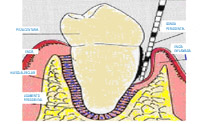 Estado de los tejidos en la enfermedad periodontal.