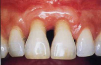 Recesión periodontal de las encías.