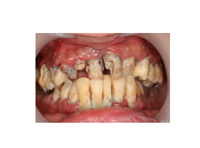 Peridontitis rápidamente progresiva de las encías.