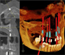 Imagen de implantes dentales.