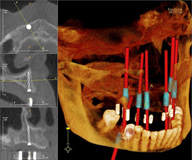 Imagen de implantes dentales.