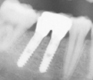 Radiografía de unos implantes dentales.