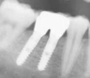 Imagen de una radiografía de implantes dentales.