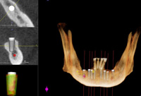 Imagen de detalle de implante dental.