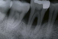 Radiografía dental en la que se aprecian la presencia de furcas dentales.